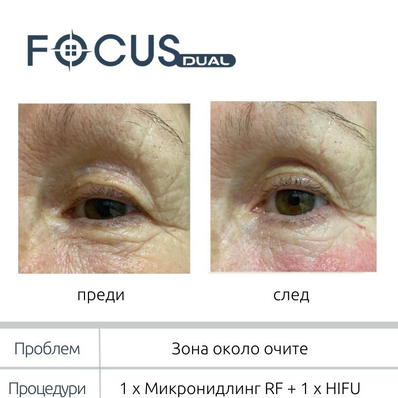 Зона около очите преди и след процедури с FOCUS DUAL във Vitalaiz