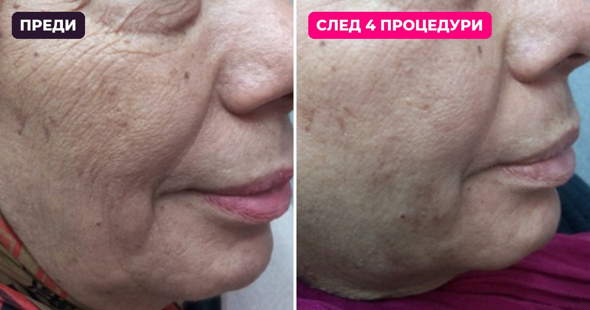 Фракционен CO2 лазер SMAXEL, клинично проучване